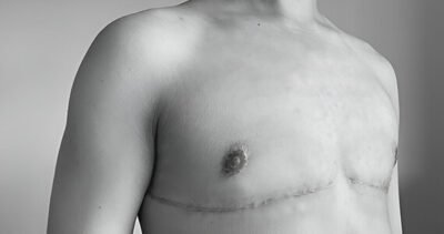 Double Incision Top Surgery and Cost for Transmen by Dr. Meghna
