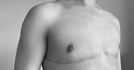 Double Incision Top Surgery for Transmen -01