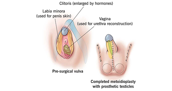 Metoidioplasty Surgery -01