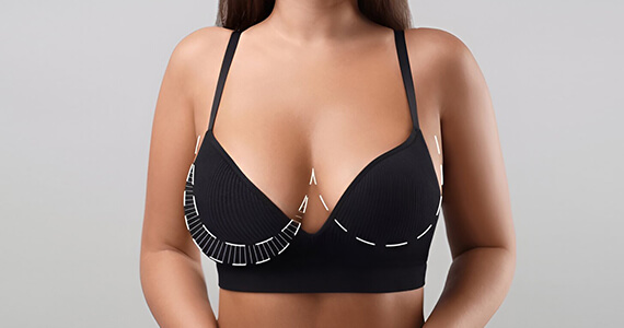 Periareolar Top Surgery -01
