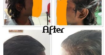 Hair Transplant Women
