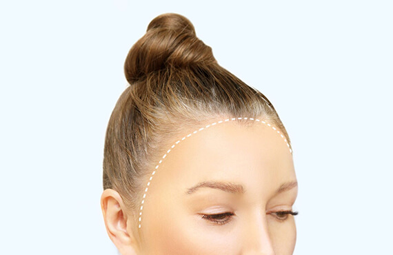 Hairline Advancement Surgery for Transwomen -01 Hairline Advancement Surgery for Transwomen