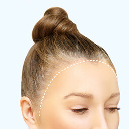 Hairline Advancement Surgery for Transwomen