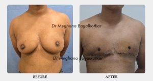 Double incision before after - Dr Meghana Bagalkotkar 01
