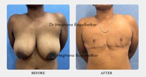 Double incision before after - Dr Meghana Bagalkotkar 02