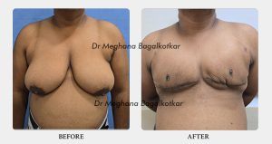 Double incision before after - Dr Meghana Bagalkotkar