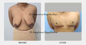 double incision before after